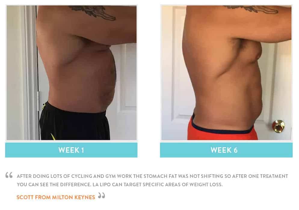 Before & After Stomach Fat Sunderland