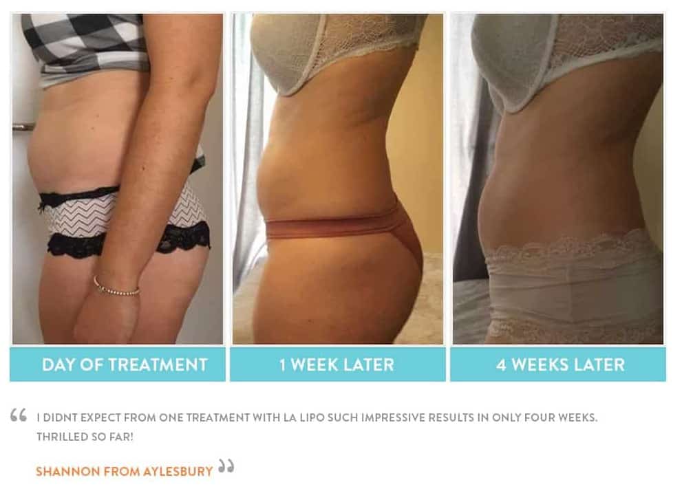 before, Cryolipolysis Sunderland