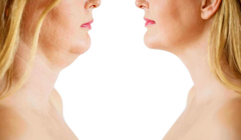 Double Chin treatment Sunderland before and after results