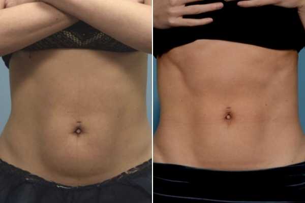 body sculpting FAQs Sunderland