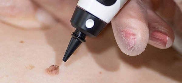 After Skin Tag Removal Sunderland