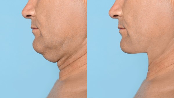 Which Non-Surgical Treatments Work Best for Jowls and Loose Skin Sunderland?
