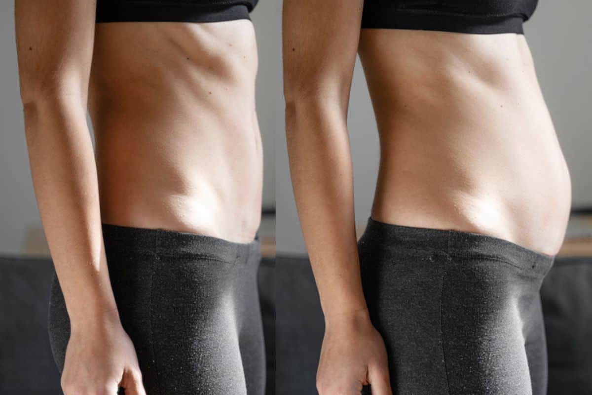 How long does diastasis recti take to improve Sunderland?