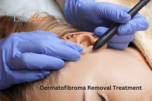 Dermatofibroma Removal Treatment Sunderland