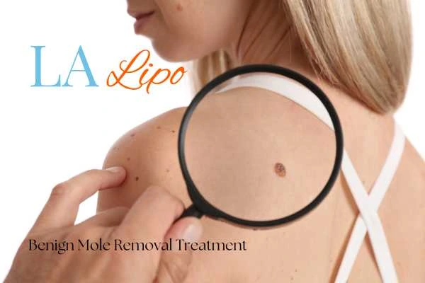 Woman having her inspection of blemish before mole removal Sunderland