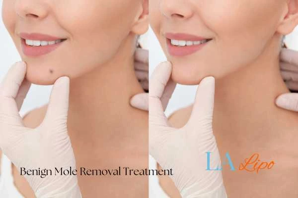 Before and after mole removal Sunderland treatment