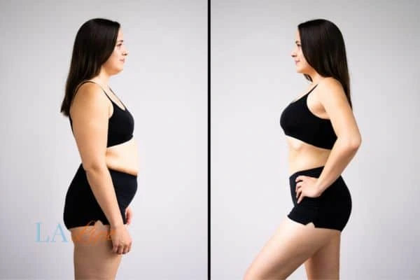 image of woman before and after results of LA-EMS Body Sculpting Sunderland to help treat Diastasis recti