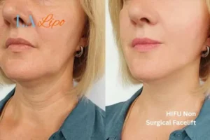 hi-fu for wrinkles Sunderland before and after results