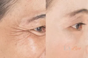 Before and after results of woman - HI-fu wrinkles reduction treatment Sunderland