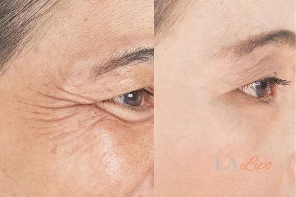 Before and after results of woman - HI-fu wrinkles reduction treatment Sunderland