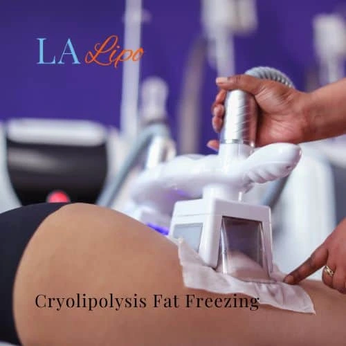 fat freezing - Cryolipolysis Sunderland