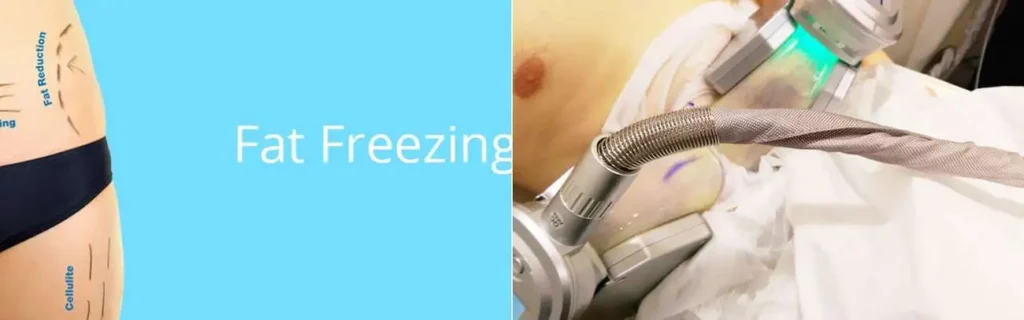 Fat freezing Sunderland on multiple areas of the body