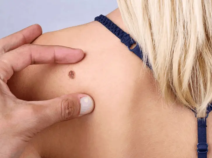 woman having mole removal Sunderland consultation before treatment.