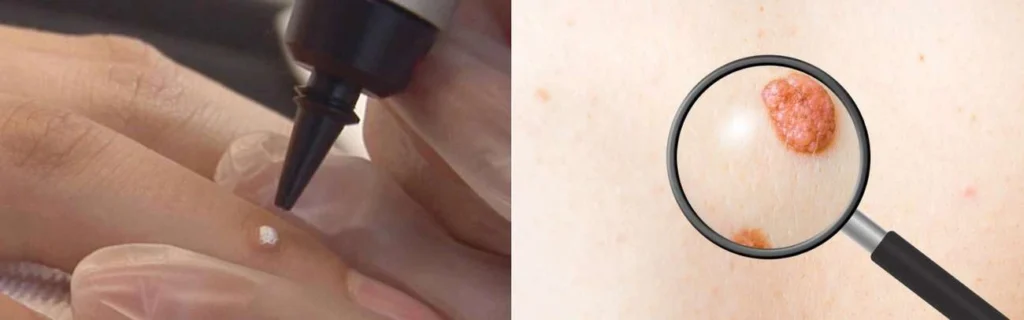 Person getting moles removed with cryopen Sunderland