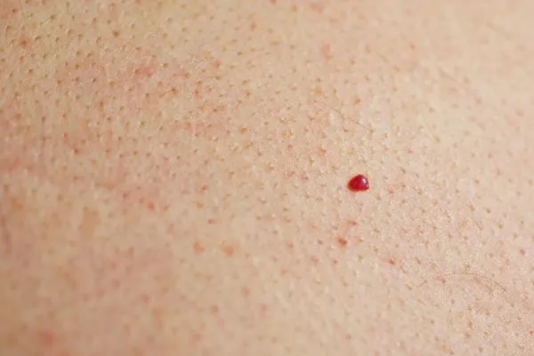 close up of a cherry angioma Sunderland