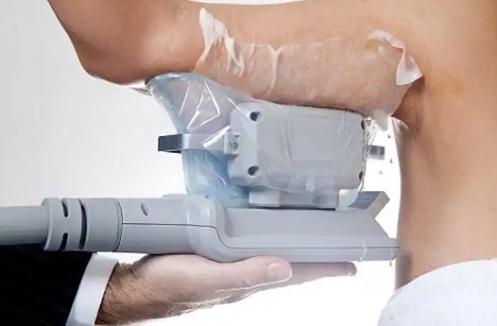 Picture of fat freezing Sunderland on the upper arms.