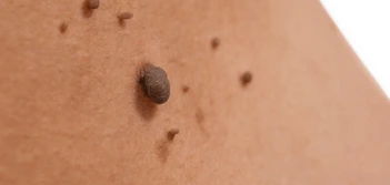 image of a skin tag Sunderland