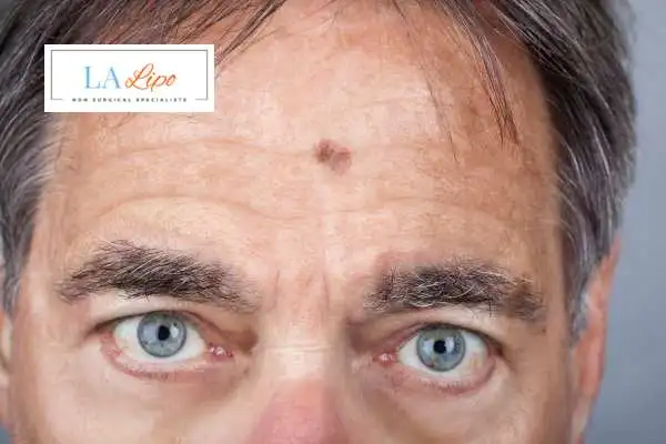 Solar Lentigo Removal Sunderland image of man with mark on his forehead