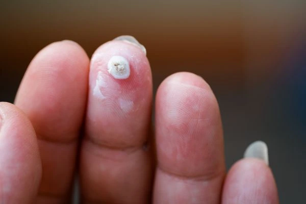 wart on person finger - cryotherapy to treat from LA LIPO Sunderland