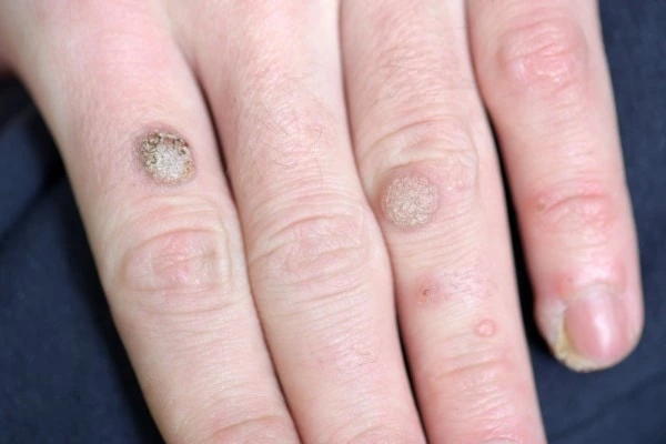 photo of warts on person hand - see wart removal Sunderland from LA LIPO