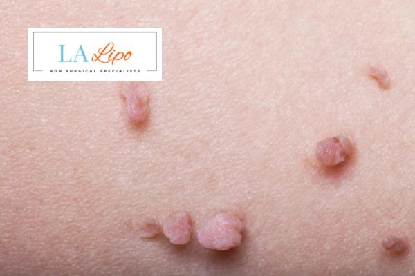 Does cryopen skin tag removal Sunderland hurt? Find out now call our team today!