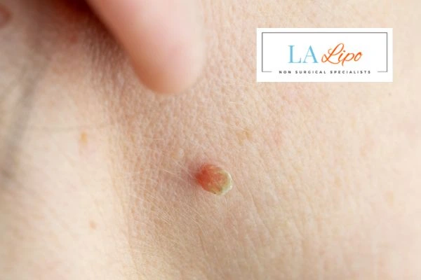 Book skin tag removal Sunderland today speak to our team now!