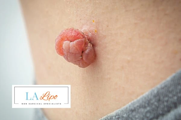 Interested in skin tag removal Sunderland? Concerned about the pain? Find out more today!