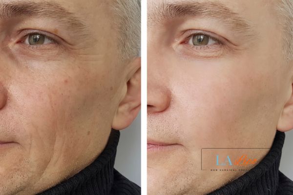 See the amazing results of Morpheus8 Treatment Sunderland!