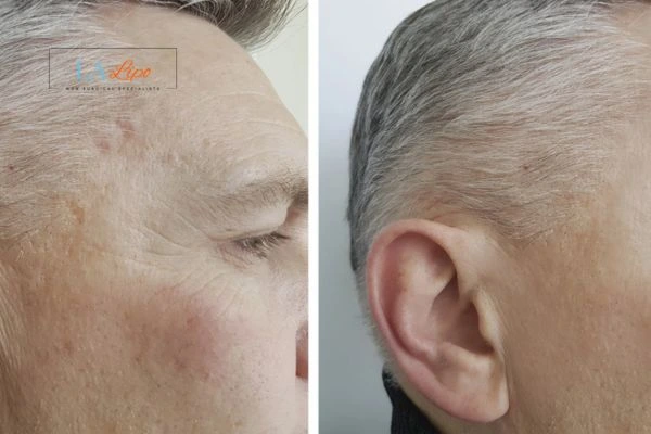 Mens Before & After Morpheus 8 Results Sunderland