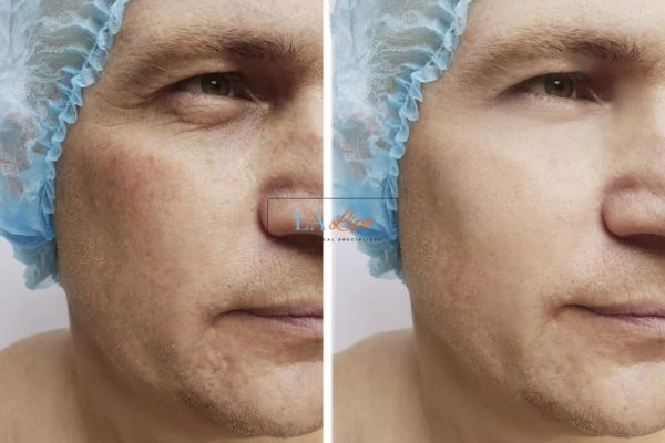 Before and after Morpheus 8 Results Sunderland