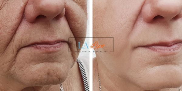Older lady deeper wrinkle reduction - LA LIPO Morpheus 8 Results Sunderland