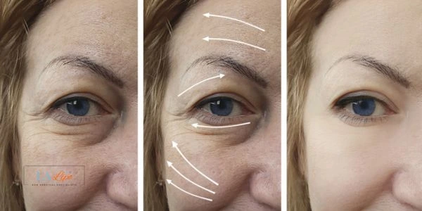 Amazing eye lift Morpheus 8 results Sunderland