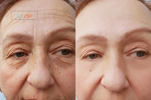 The powerful benefits of Morpheus8 Treatment Sunderland - Call Our team today!