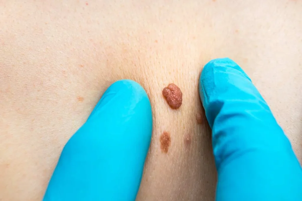 LA LIPO Cryopen Lesion Removal Prices Sunderland