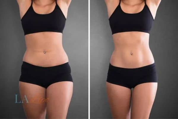before and after results of non-surgical treatment to help a woman's body image and mental health Sunderland