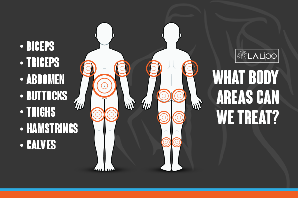 Diagram to show areas you can have LA-EMS Body Sculpting Treatment Sunderland
