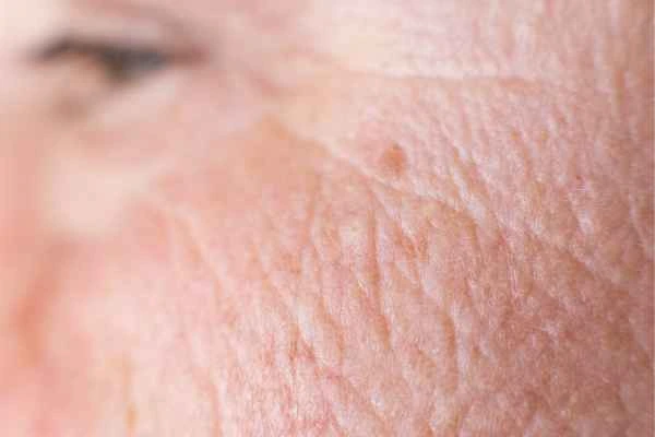 close up picture of a woman's face showing an age spot Sunderland
