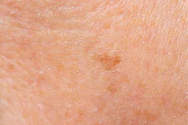 close up picture of age spots Sunderland