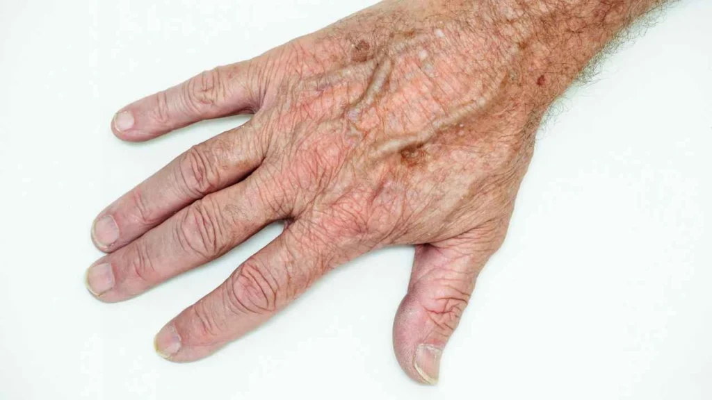 Male hand showing age spot Sunderland