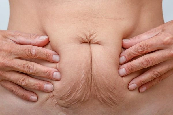 Image of a woman's stomach with loose skin - example of skin tightening Sunderland options