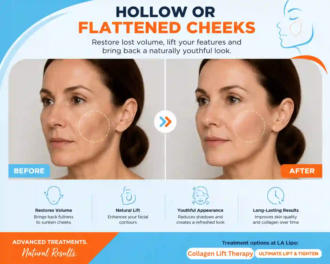 Sign #4: Hollow or Flattened Cheeks Sunderland