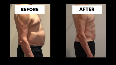 What Symptoms Can Diastasis Recti Cause in Men? Weak Core, Back Pain and Poor Posture Sunderland
